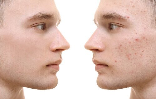 Acne treatment at Malouf Dermatology in Dallas-Fort Worth by Dr. Peter Malouf.