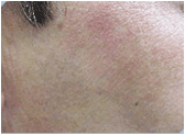 IPL photofacial treatment for sun damage and redness.