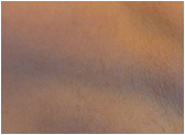 Laser hair removal treatment in Dallas-Fort Worth.