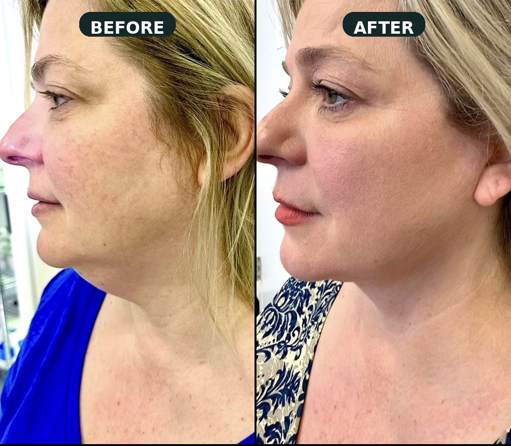 Safelift mini-facelift under local anesthesia at Malouf Dermatology.