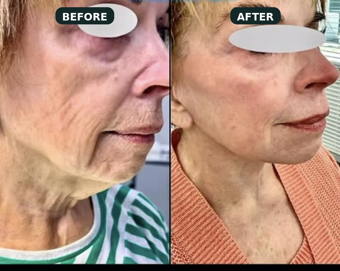 Mini neck lift result — jawline definition without general anesthesia.