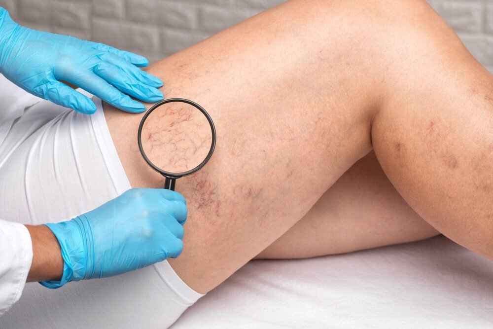Sclerotherapy for leg spider veins at Malouf Dermatology.