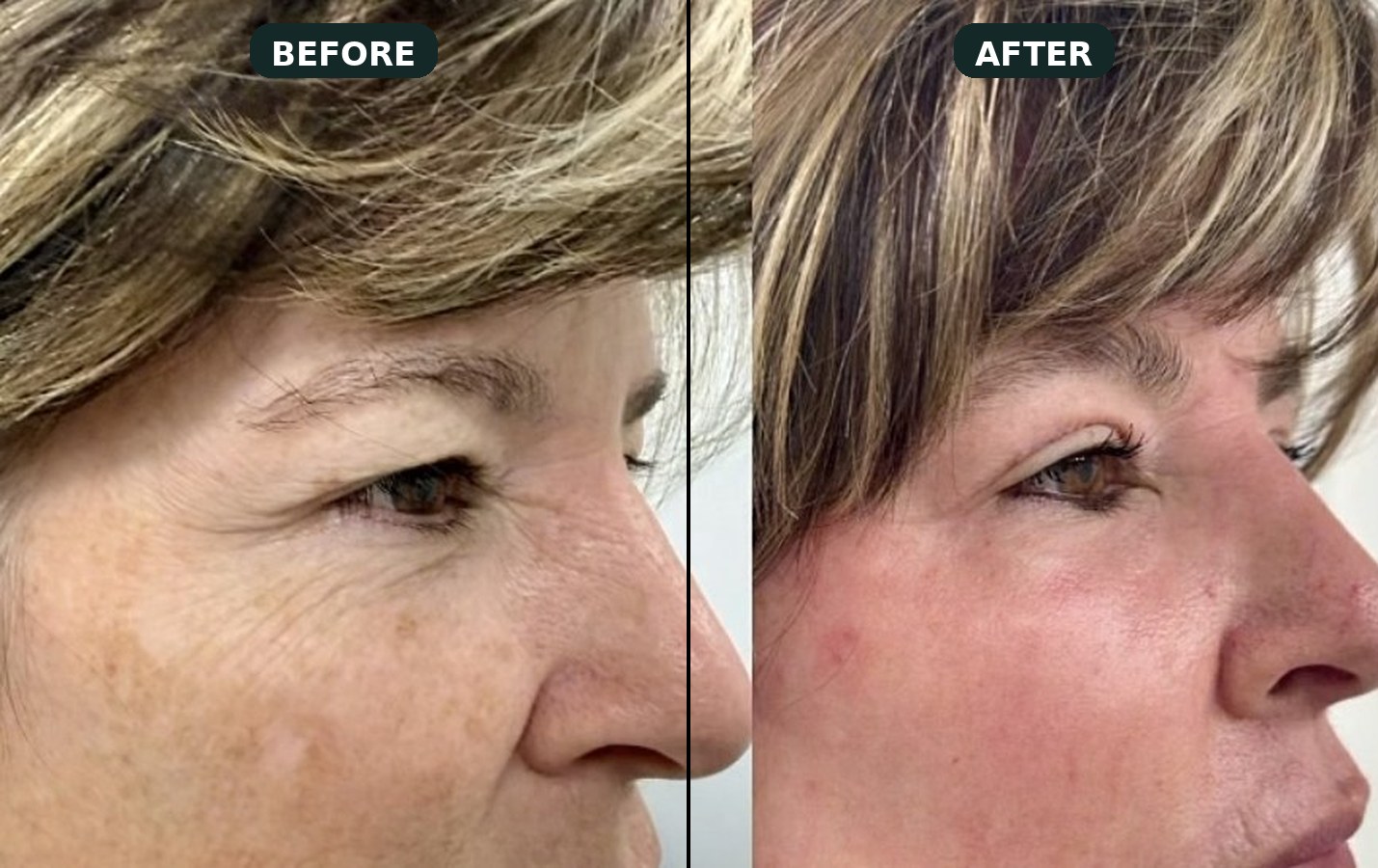 Upper-lid blepharoplasty under local anesthesia at Malouf Dermatology.